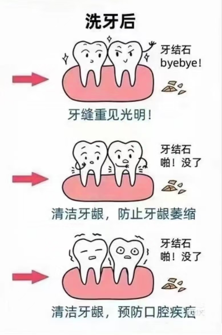 医生，我来种牙，为什么要种骨头